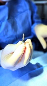 fotografia de un implante dental